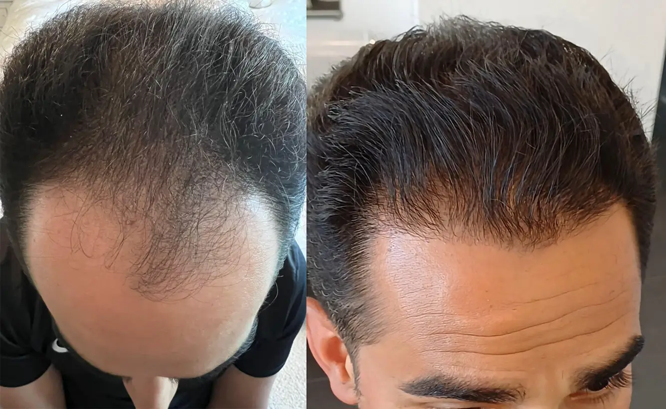 Before / After 14